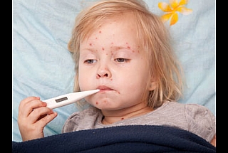 הכל על אבעבועות רוח