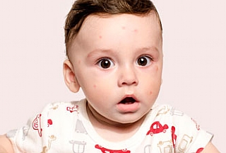 אדמדמת תינוקות - תסמינים ודרכי טיפול