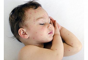 פריחה אצל תינוקות - אבחנות אפשריות ומה אפשר לעשות פריחה אצל תינוקות - אבחנות אפשריות ומה אפשר לעשות