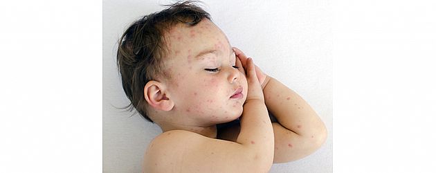 פריחה אצל תינוקות - אבחנות אפשריות ומה אפשר לעשות פריחה אצל תינוקות - אבחנות אפשריות ומה אפשר לעשות