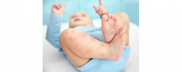 עקיצת יתוש - המדריך המלא שיעזור לכם להתמודד עם התסמינים עקיצת יתוש - המדריך המלא שיעזור לכם להתמודד עם התסמינים